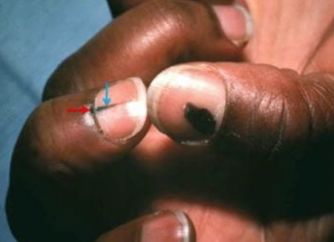 指甲盖上起竖纹、白斑是“死亡信号”？4种状况要警惕→